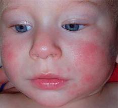 बच्चे और इसके मुख्य अभिव्यक्तियों में एलर्जी