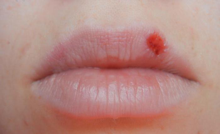 होंठ पर अंक लाल होते हैं: उपस्थिति के कारण और उपचार के तरीके
