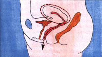 योनि हिस्टेरेक्टोमी - चालन और इसके परिणामों के संकेत